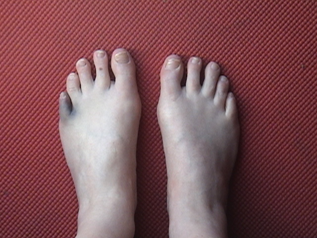 beckys-broken-toe